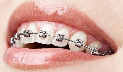 4 Important Benefits of Wearing Braces